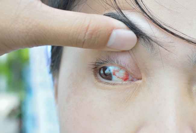 Ini Serius, Jaga Baik-baik Kesehatan Pembuluh Darah - Alodokter