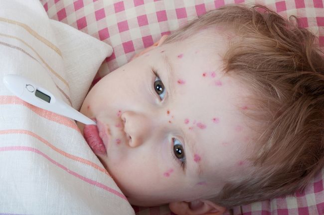 Portrait of little boy with chickenpox