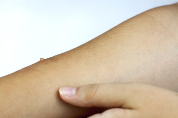 Molluscum Contagiosum