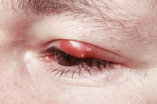Stye