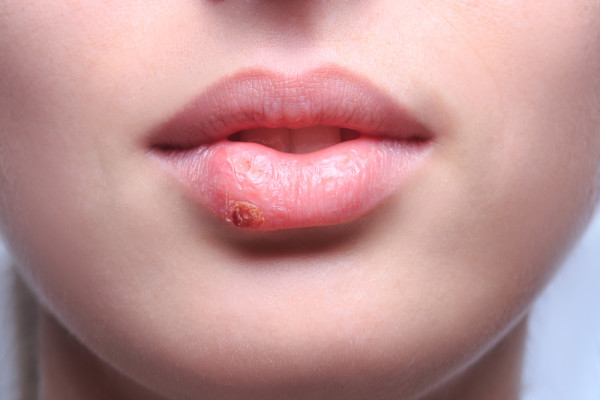 Herpes