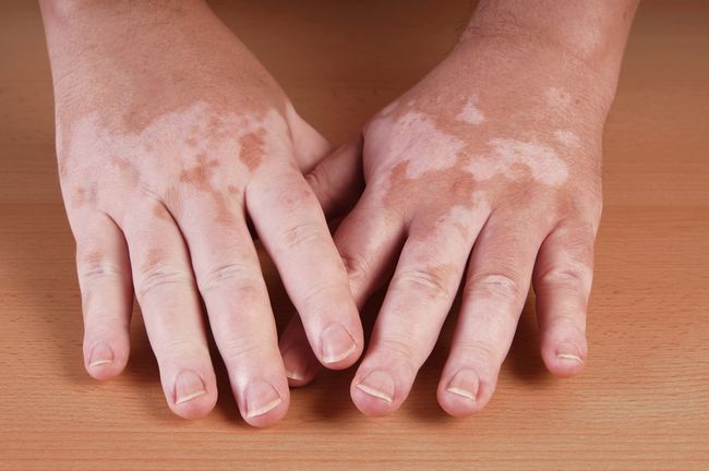 Vitiligo Gejala Penyebab Dan Mengobati Alodokter