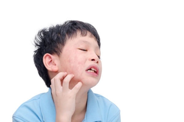 Pityriasis Alba