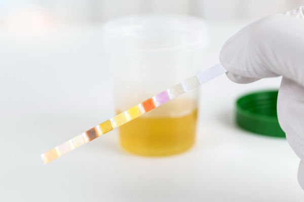 Urine turbidity 