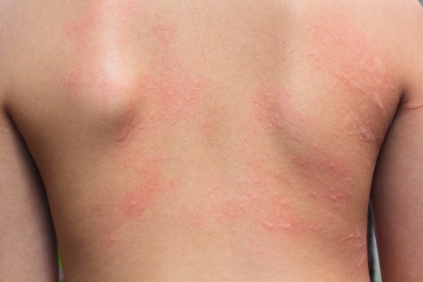 Drug Allergy