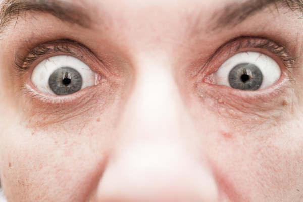 Exophthalmos