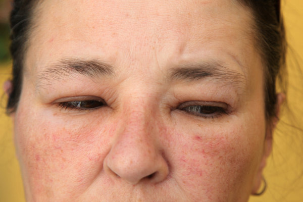หน้าบวม (Facial Swelling) - อาการ, สาเหตุ, การรักษา - Pobpad หน้าบวม (Facial Swelling) - อาการ, สาเหตุ, การรักษา - Pobpad