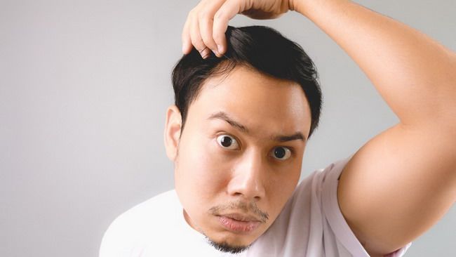 Penyebab dan Cara Mengatasi Kebotakan