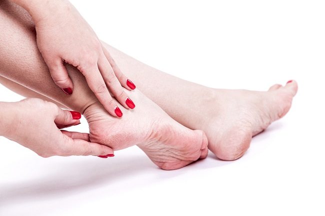 cracked heels