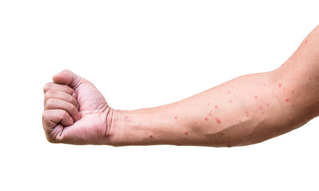 Kisah Inspiratif: Pria di California Sembuh dari HIV dan Kanker Darah