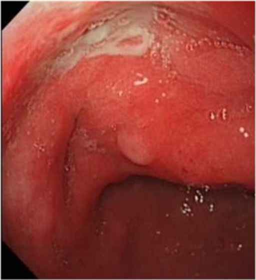 Endoskopi esofagogastroduodenoskopi: gastritis. Sumber: Wang L, Openi, 2014