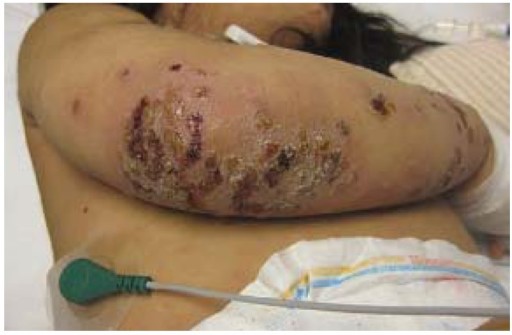 Impetigo krustosa. Sumber: anonim, Openi, 2015.