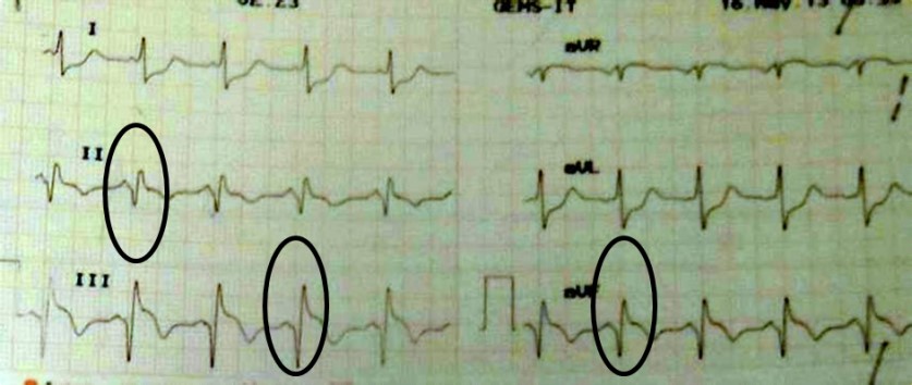 Ekg Infark Miokard