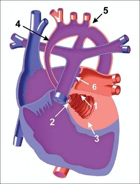 Sindrom hipoplasia jantung kiri. Sumber: anonim, Openi, 2011.