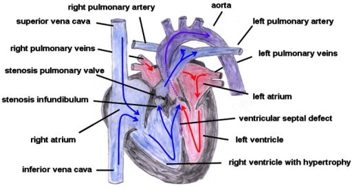 Atrial Septal Defect Adalah Pdf