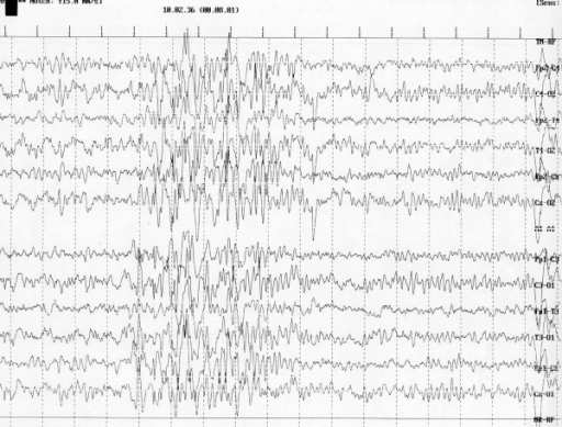 Gambaran EEG epilepsi. Sumber: anonim, Openi, 2010.