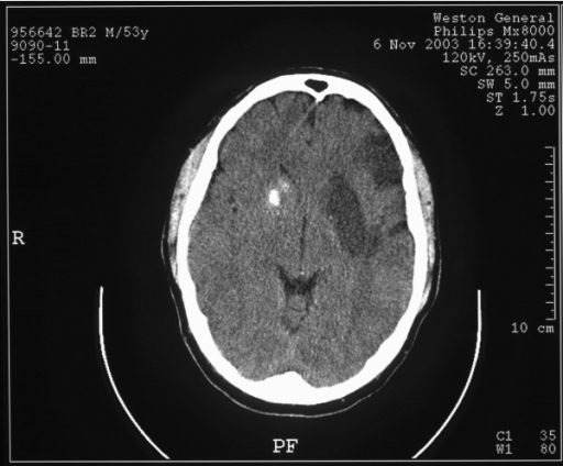 Gambaran CT scan stroke iskemik. Sumber: anonim, Openi, 2008.