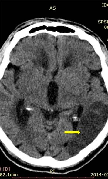 CT Scan Stroke iskemik. Sumber: anonim, Openi, 2015.