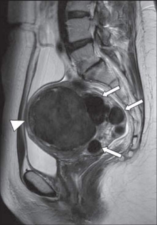 MRI menorrhagia. Sumber: anonim, Openi, 2009.