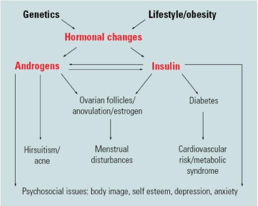 Patofisiologi PCOS. Sumber: anonim, Openi, 2010.
