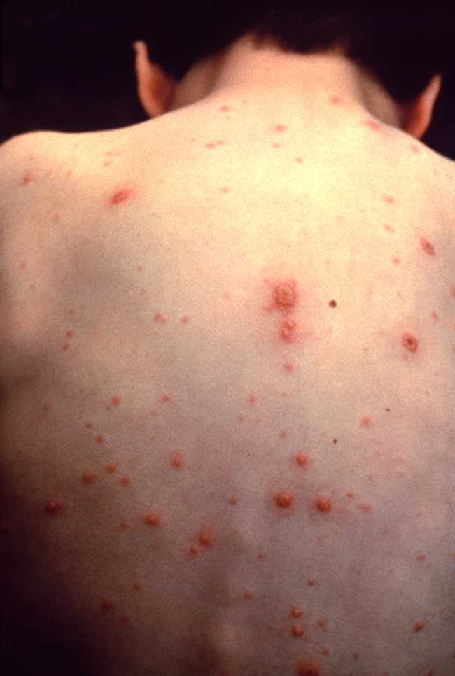 Varisela pankorporeal. Sumber: anonim, PHIL CDC, 1995.