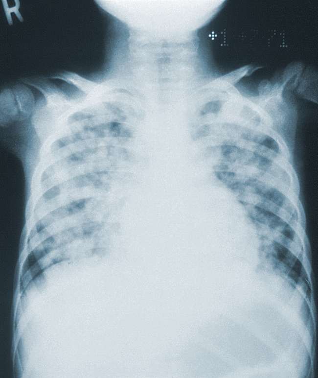 Pneumonia varisela. Sumber: JD Meyers, PHIL CDC, 1973.