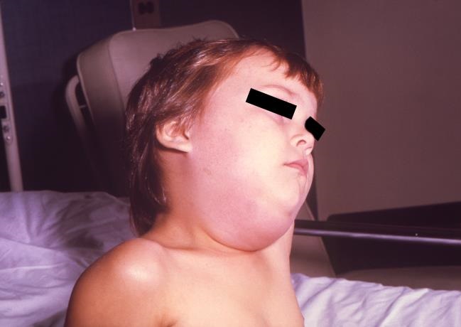 Mumps. Sumber: anonim, PHIL CDC, 1976.