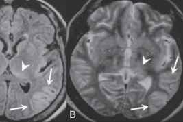 MRI malaria serebral. Sumber: Gupta S, Openi, 2008.