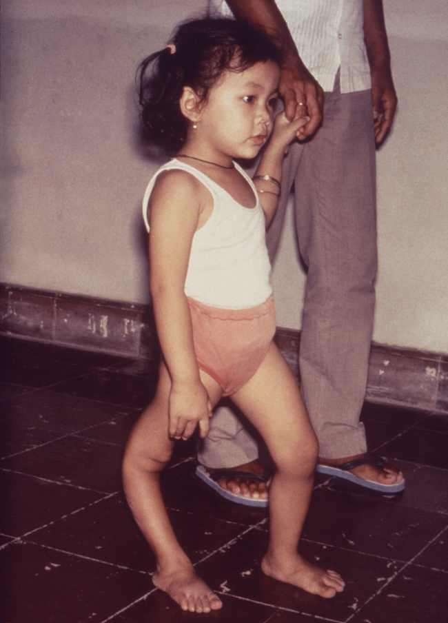 Polio. Sumber: anonim, PHIL CDC, 1995.