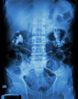 Nefrolitiasis adalah