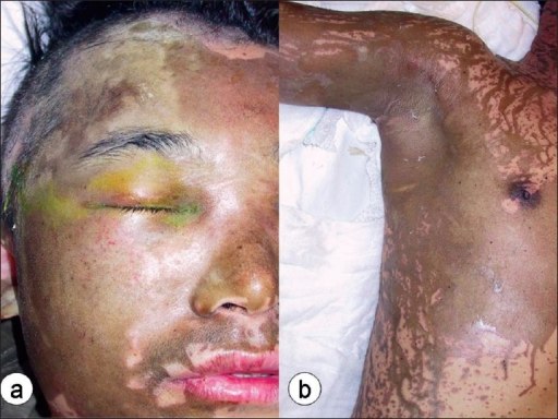 Luka bakar kimia akibat siraman asam. Sumber: anonim, Openi, 2010.