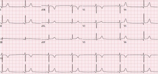 Download 580 Gambar Grafik Ekg Normal Paling Baru HD