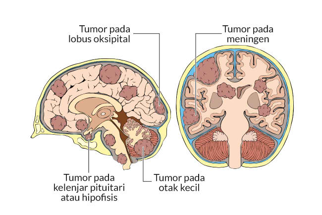 Penyebab Kanker Otak yang Perlu Diwaspadai