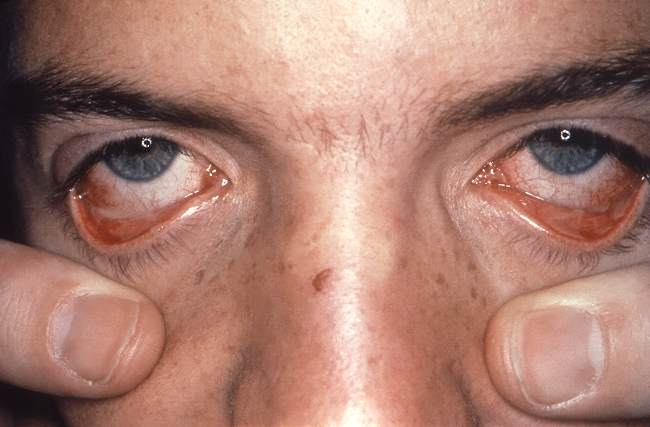 Sumber: RE Sumpter, PHIL CDC, 1967.