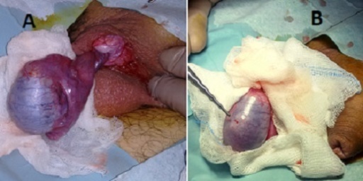 Gambar: torsio testis. Sumber: anonim, Openi, 2015.