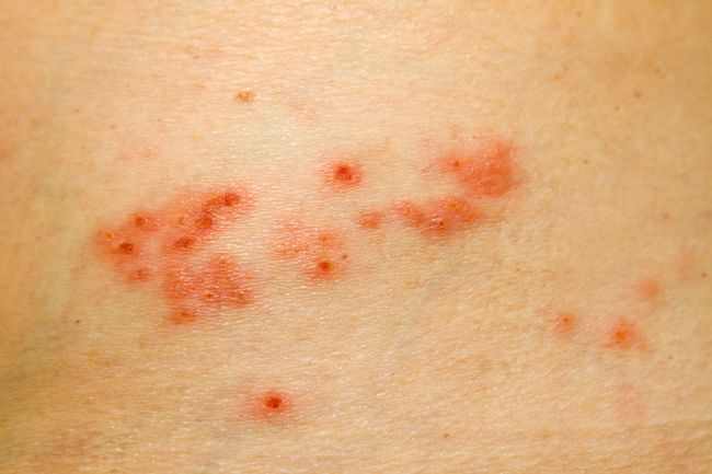 Herpes Zoster Gejala Penyebab Dan Mengobati Alodokter