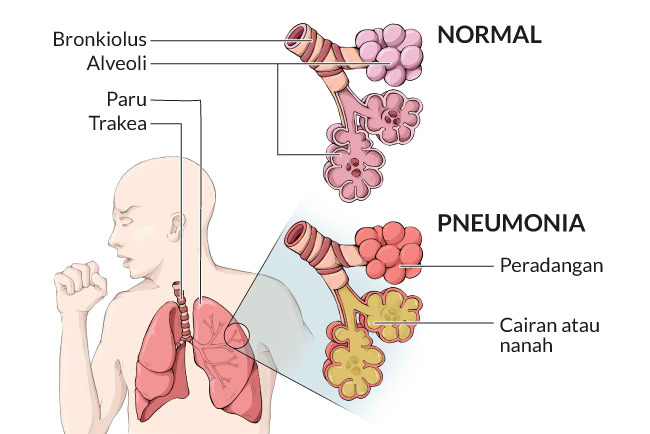 Pneumonia Gejala penyebab dan mengobati Alodokter