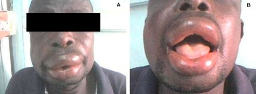 Angioedema wajah akibat alergi makanan. Sumber: anonim, Openi, 2009.