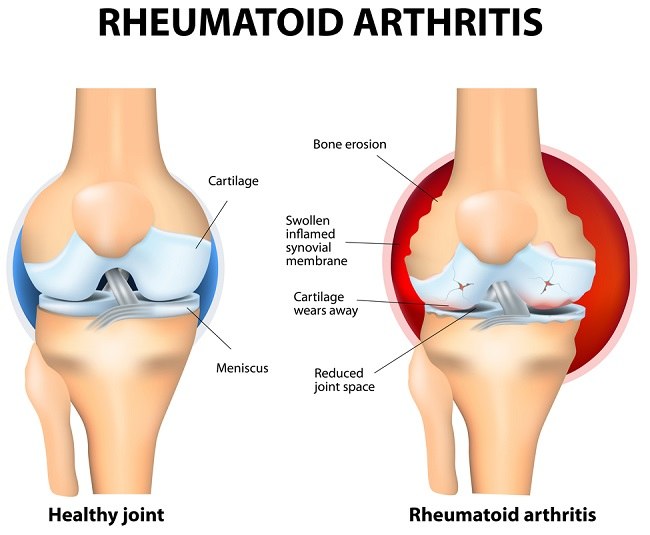 Rheumatoid Arthritis Patofisiologi Diagnosis Penatalaksanaan