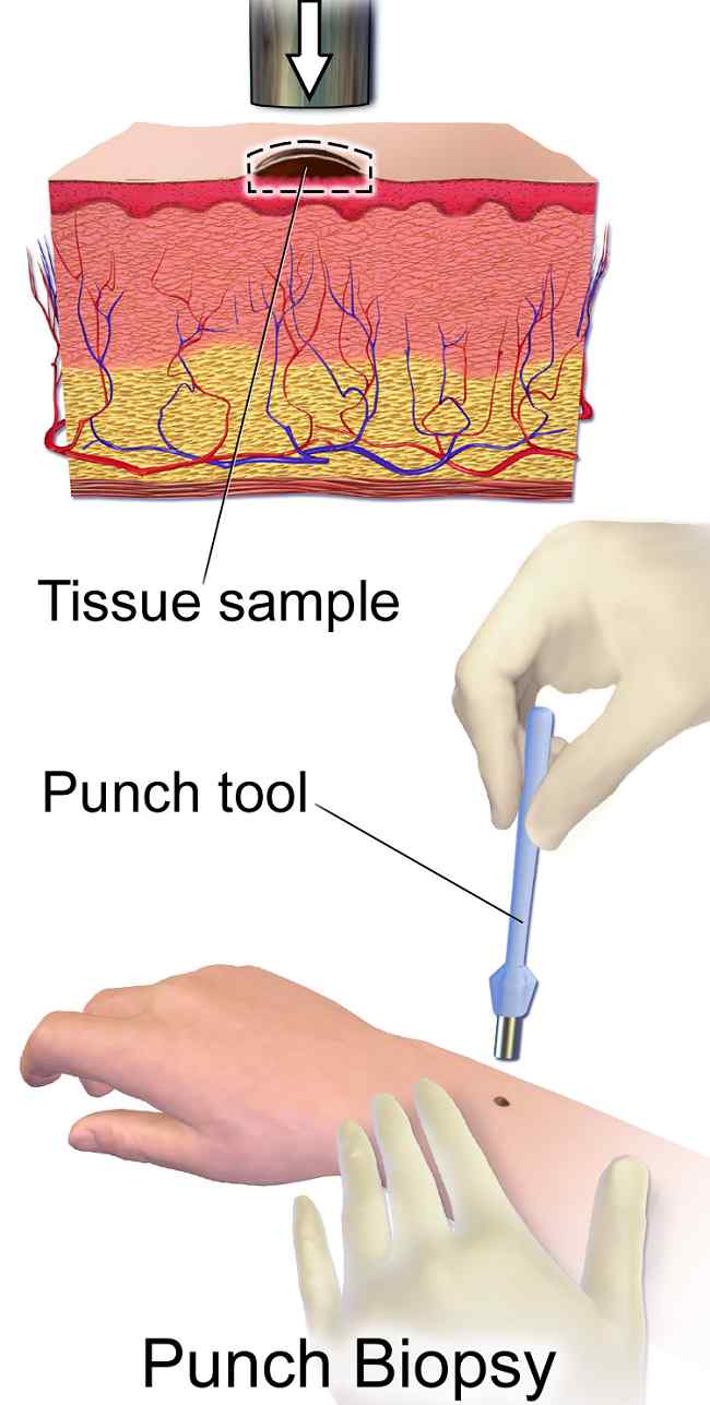 Gambar: Punch Biopsy. Sumber: BruceBlaus, Wikimedia commons, 2017.