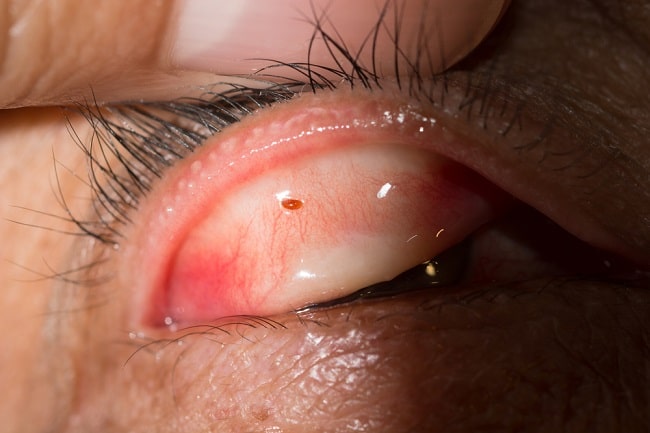 Ekstraksi Benda Asing Konjungtiva Patofisiologi Diagnosis Penatalaksanaan Alomedika