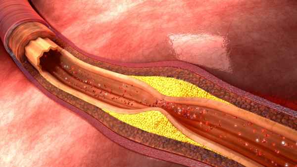 Atherosclerosis