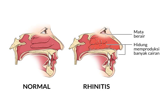  Rhinitis  Gejala penyebab dan mengobati Alodokter