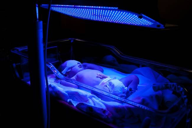 Manfaat Fototerapi Untuk Bayi Kuning Alodokter