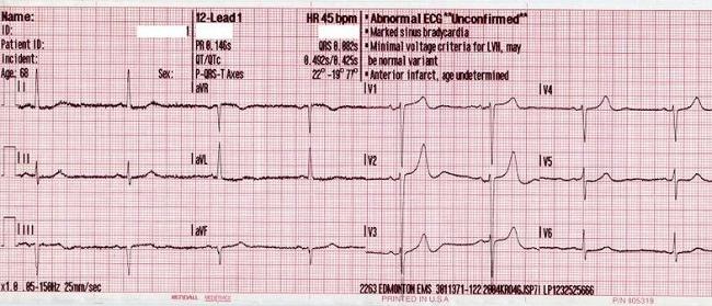 Unduh 570 Gambar Ekg Jantung Koroner  HD