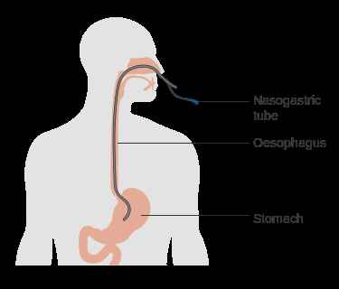 Nasogastric Tube. Sumber: Cancer Research UK/Wikimedia Commons