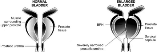 Prostat normal dan membesar. Sumber: anonim, Openi, 2011.