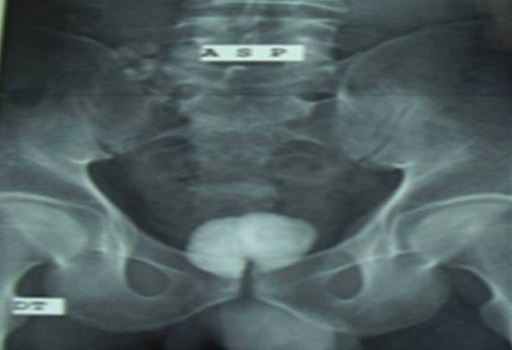 A meddőség okai Prostatitis Krónikus betegség- betegség prosztatitis