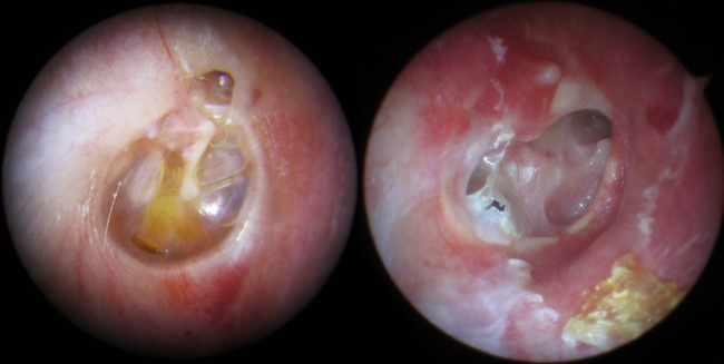 Otitis media akut Sumber: Openi 2013