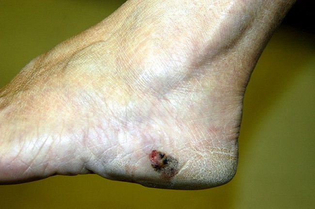 Melanoma maligna pada kaki kiri. Sumber: Will Blake, Wikimedia commons, 2006.